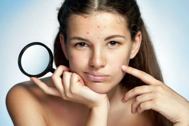 痘痘肌膚適合用什么面霜 痘痘肌的形成原因 痘痘肌膚適合用什么面霜 痘痘肌的形成原因