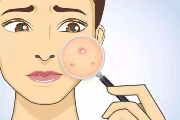 痘痘肌膚會不會遺傳 痘痘肌膚會自動修復(fù)嗎 痘痘肌膚會不會遺傳 痘痘肌膚會自動修復(fù)嗎
