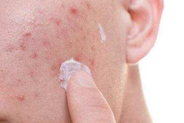 痘痘肌膚怎么修復(fù) 痘痘肌膚適合用什么牌子的護(hù)膚品 痘痘肌膚怎么修復(fù) 痘痘肌膚適合用什么牌子的護(hù)膚品