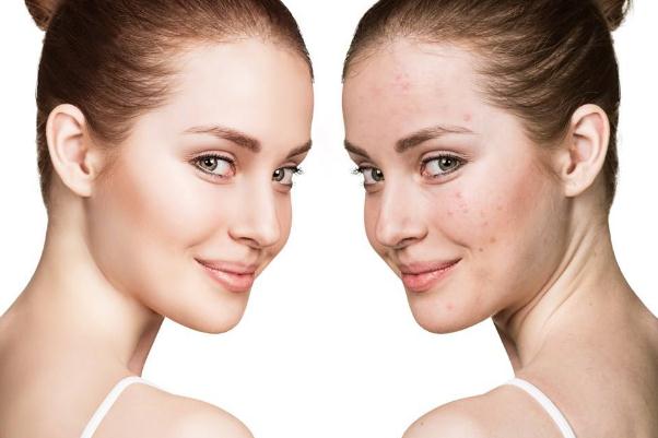 痘痘肌膚會(huì)不會(huì)遺傳 痘痘肌膚會(huì)自動(dòng)修復(fù)嗎 痘痘肌膚會(huì)不會(huì)遺傳 痘痘肌膚會(huì)自動(dòng)修復(fù)嗎