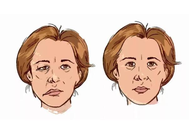 面癱是什么病 女子回家路上被冷風(fēng)吹成面癱 面癱是什么病 女子回家路上被冷風(fēng)吹成面癱