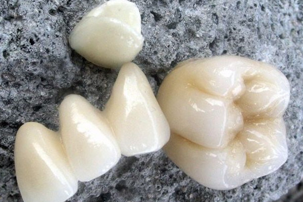 烤瓷牙里面臭了怎么辦 烤瓷牙怎么清洗里面 烤瓷牙里面臭了怎么辦 烤瓷牙怎么清洗里面