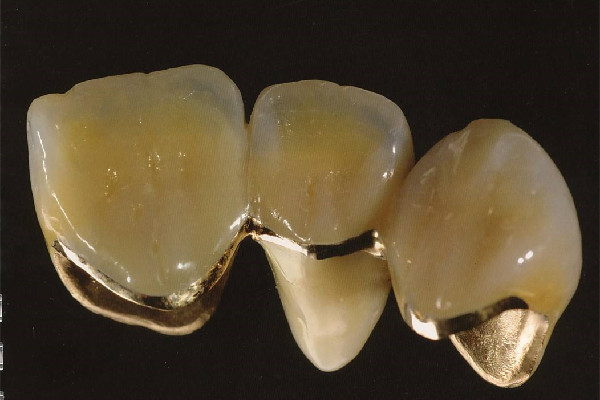 烤瓷牙怎么選擇價(jià)位 烤瓷牙怎么選擇顏色