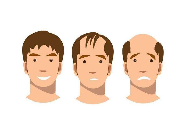 發(fā)際線會(huì)長回來嗎 發(fā)際線和年齡有關(guān)系嗎 發(fā)際線會(huì)長回來嗎 發(fā)際線和年齡有關(guān)系嗎