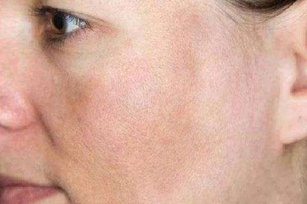 色素沉著能祛除嗎 色素沉著怎么快速去除 色素沉著能祛除嗎 色素沉著怎么快速去除