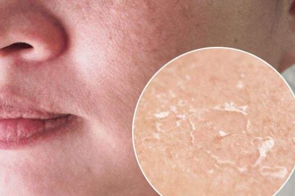 皮膚干燥脫皮嚴(yán)重像魚鱗怎么辦 皮膚干燥起皮像魚鱗是怎么回事 皮膚干燥脫皮嚴(yán)重像魚鱗怎么辦 皮膚干燥起皮像魚鱗是怎么回事