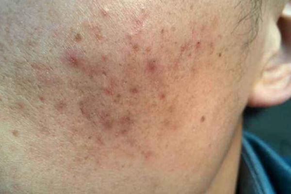 色素沉著能祛除嗎 色素沉著怎么快速去除 色素沉著能祛除嗎 色素沉著怎么快速去除