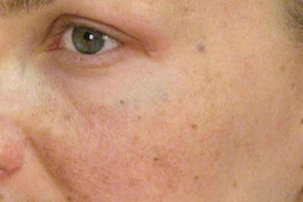 色素沉著能祛除嗎 色素沉著怎么快速去除 色素沉著能祛除嗎 色素沉著怎么快速去除