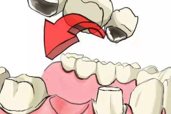 鑲牙的壽命是多長時(shí)間 鑲牙的危害 鑲牙的壽命是多長時(shí)間 鑲牙的危害