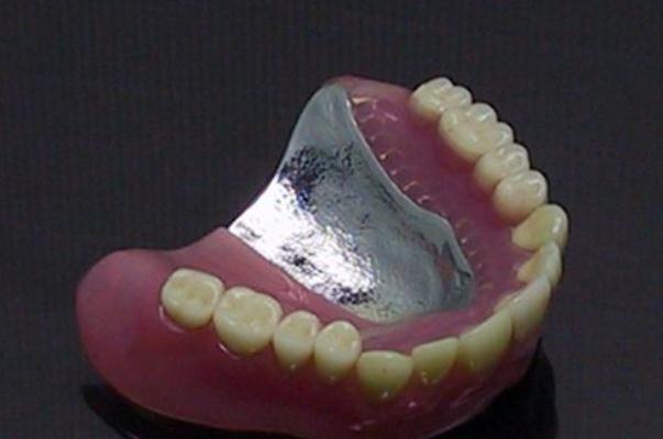 鑲牙要把牙根拔掉嗎 鑲牙有幾種方式哪個好 鑲牙要把牙根拔掉嗎 鑲牙有幾種方式哪個好