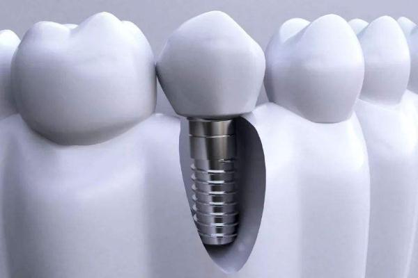 鑲牙要把牙根拔掉嗎 鑲牙有幾種方式哪個好 鑲牙要把牙根拔掉嗎 鑲牙有幾種方式哪個好