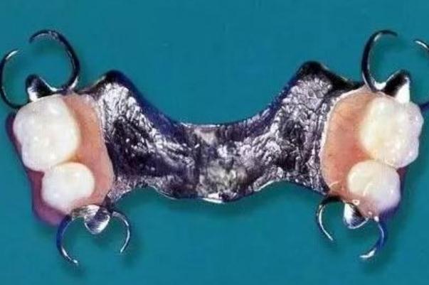 鑲牙要多長時(shí)間才能完成 鑲牙后的注意事項(xiàng) 鑲牙要多長時(shí)間才能完成 鑲牙后的注意事項(xiàng)