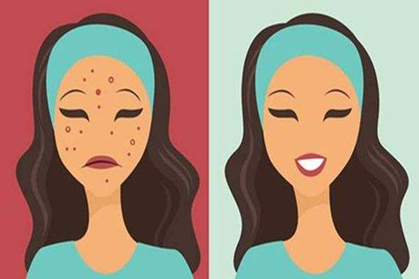 痘痘擠了之后怎么處理 痘痘擠了之后會留痘印嗎 痘痘擠了之后怎么處理 痘痘擠了之后會留痘印嗎