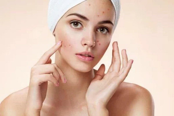 痘痘擠了一直流血怎么辦 痘痘擠了一半沒擠干凈怎么辦 痘痘擠了一直流血怎么辦 痘痘擠了一半沒擠干凈怎么辦