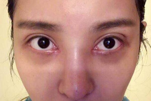 割雙眼皮可以吃炸雞嗎 割雙眼皮后護理 割雙眼皮可以吃炸雞嗎 割雙眼皮后護理