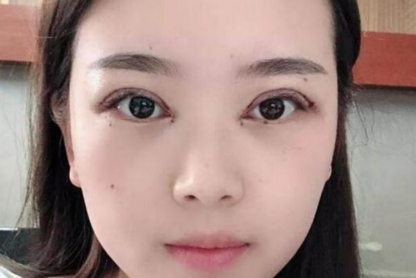 割雙眼皮需要多少錢(qián)一次 割雙眼皮大概多久能恢復(fù)正常 割雙眼皮需要多少錢(qián)一次 割雙眼皮大概多久能恢復(fù)正常
