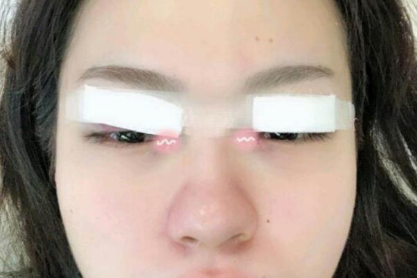 割雙眼皮有幾種方法 割雙眼皮有什么壞處 割雙眼皮有幾種方法 割雙眼皮有什么壞處