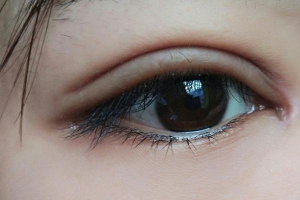 割雙眼皮后不能吃什么 割雙眼皮的后遺癥 割雙眼皮后不能吃什么 割雙眼皮的后遺癥