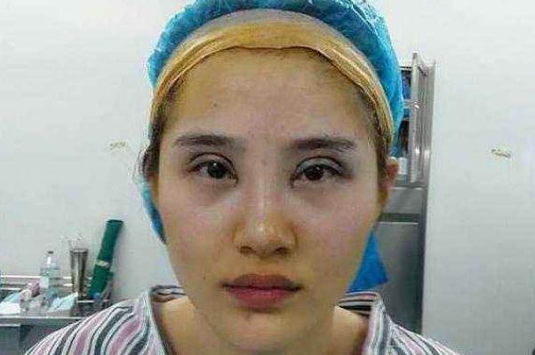 割雙眼皮需要多少錢(qián)一次 割雙眼皮大概多久能恢復(fù)正常 割雙眼皮需要多少錢(qián)一次 割雙眼皮大概多久能恢復(fù)正常