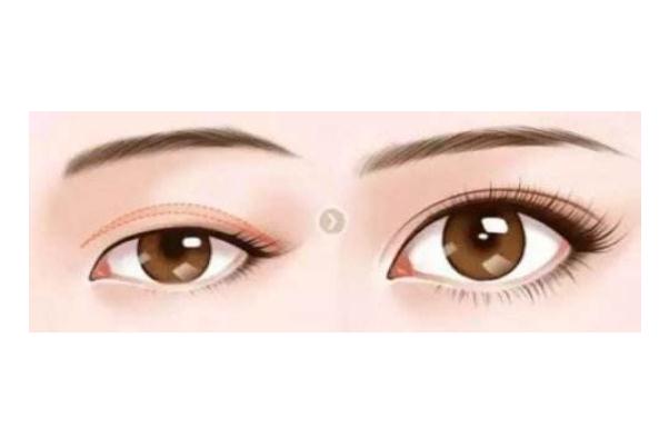 割雙眼皮要冰敷幾天 割雙眼皮要不要做翹睫 割雙眼皮要冰敷幾天 割雙眼皮要不要做翹睫