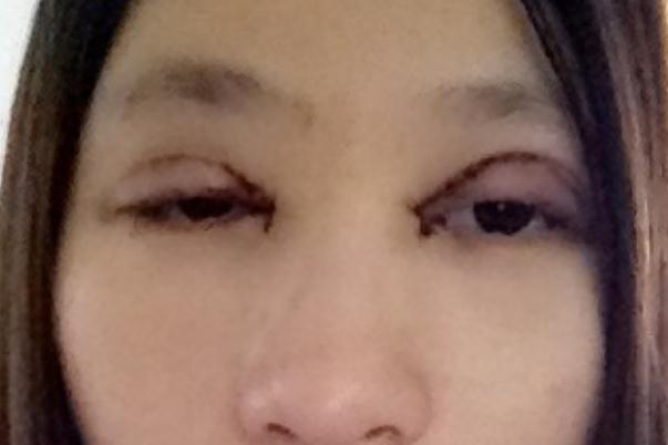割雙眼皮后不能吃什么 割雙眼皮的后遺癥 割雙眼皮后不能吃什么 割雙眼皮的后遺癥