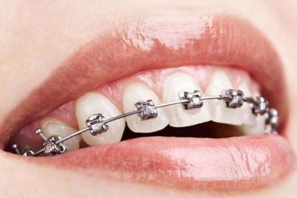 牙套的種類和價(jià)格 牙套價(jià)格一般是多少錢(qián)一個(gè)