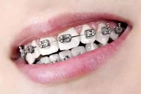 牙套的種類和價(jià)格 牙套價(jià)格一般是多少錢(qián)一個(gè)