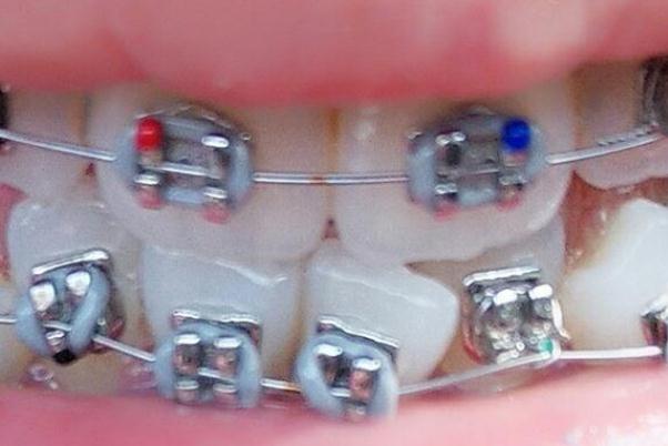 牙套會(huì)使牙齒松動(dòng)嗎 牙套會(huì)不會(huì)掉下來 牙套會(huì)使牙齒松動(dòng)嗎 牙套會(huì)不會(huì)掉下來