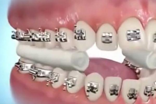 牙套是隱形的好還是鋼絲的好 牙套是怎么做上去的 牙套是隱形的好還是鋼絲的好 牙套是怎么做上去的