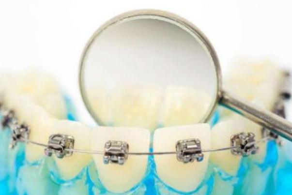 牙套是隱形的好還是鋼絲的好 牙套是怎么做上去的 牙套是隱形的好還是鋼絲的好 牙套是怎么做上去的