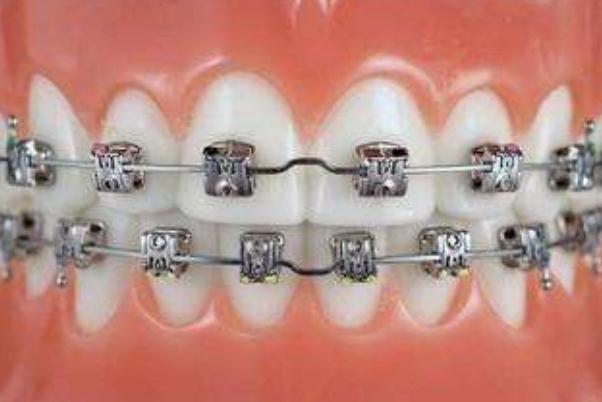 牙套是隱形的好還是鋼絲的好 牙套是怎么做上去的 牙套是隱形的好還是鋼絲的好 牙套是怎么做上去的