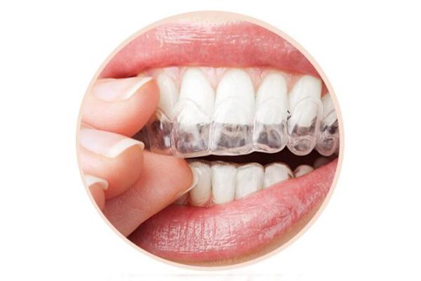 牙套的種類和價(jià)格 牙套價(jià)格一般是多少錢(qián)一個(gè)