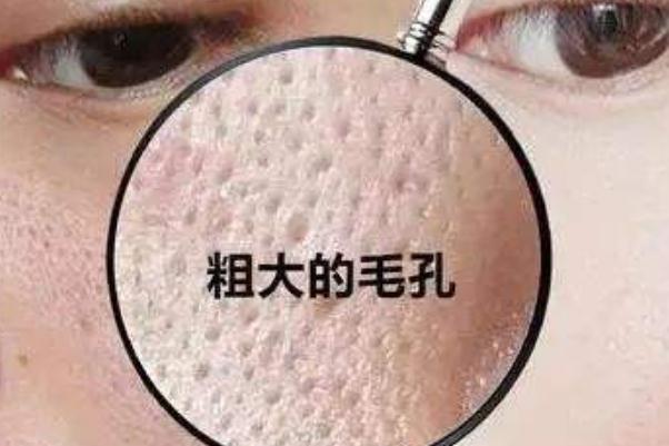 收縮毛孔的水光針叫什么 收縮毛孔是什么意思 收縮毛孔的水光針叫什么 收縮毛孔是什么意思