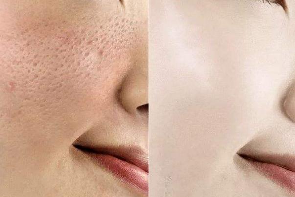 收縮毛孔的水光針叫什么 收縮毛孔是什么意思 收縮毛孔的水光針叫什么 收縮毛孔是什么意思