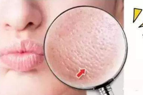 收縮毛孔會(huì)不會(huì)長(zhǎng)痘 造成毛孔粗大的因素 收縮毛孔會(huì)不會(huì)長(zhǎng)痘 造成毛孔粗大的因素