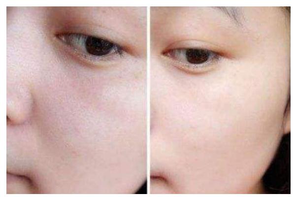 收縮毛孔最佳方法 收縮毛孔用什么比較好 收縮毛孔最佳方法 收縮毛孔用什么比較好