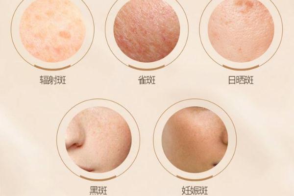 皮秒祛斑后期要怎樣護(hù)理 皮秒祛斑反黑多久能恢復(fù)正常 皮秒祛斑后期要怎樣護(hù)理 皮秒祛斑反黑多久能恢復(fù)正常