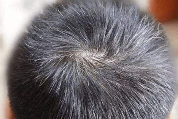 有白頭發(fā)染什么顏色好 有白頭發(fā)會(huì)遺傳嗎 有白頭發(fā)染什么顏色好 有白頭發(fā)會(huì)遺傳嗎