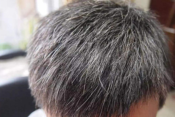 年輕人長白發(fā)是什么原因 年輕人長白頭發(fā)怎么解決 年輕人長白發(fā)是什么原因 年輕人長白頭發(fā)怎么解決