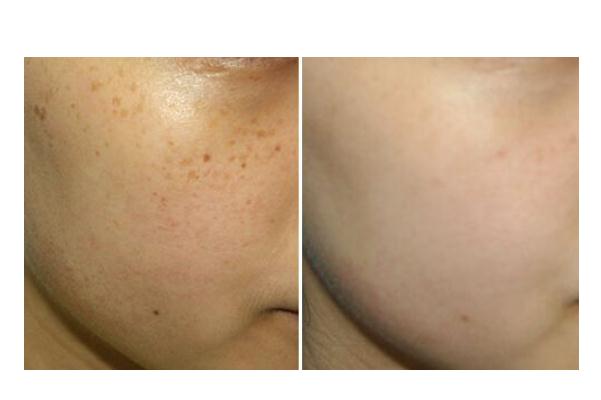 皮秒祛斑的副作用 皮秒祛斑的效果會(huì)反彈嗎 皮秒祛斑的副作用 皮秒祛斑的效果會(huì)反彈嗎