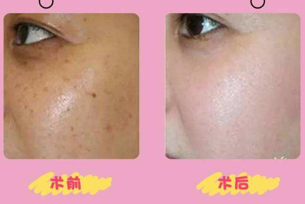 皮秒祛斑要間隔多長時(shí)間做一次 皮秒祛斑要敷麻藥嗎 皮秒祛斑要間隔多長時(shí)間做一次 皮秒祛斑要敷麻藥嗎