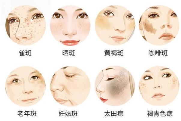 皮秒祛斑后期要怎樣護(hù)理 皮秒祛斑反黑多久能恢復(fù)正常 皮秒祛斑后期要怎樣護(hù)理 皮秒祛斑反黑多久能恢復(fù)正常