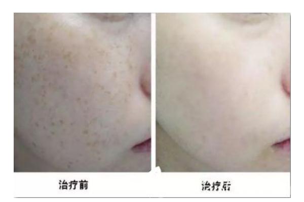 皮秒祛斑的費(fèi)用一般是多少 皮秒祛斑的危害與效果 皮秒祛斑的費(fèi)用一般是多少 皮秒祛斑的危害與效果