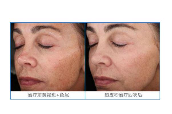 皮秒祛斑要間隔多長時(shí)間做一次 皮秒祛斑要敷麻藥嗎 皮秒祛斑要間隔多長時(shí)間做一次 皮秒祛斑要敷麻藥嗎