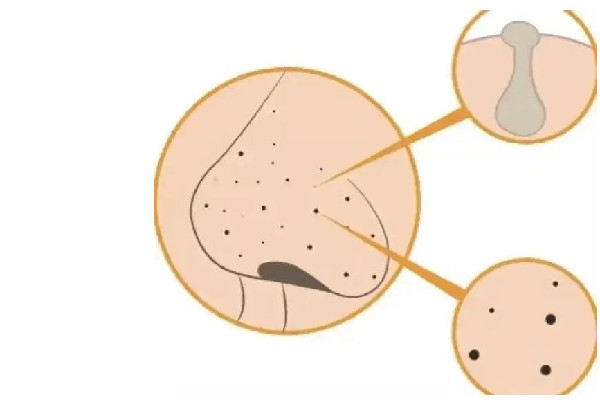 去黑頭產(chǎn)品排行榜10強 去黑頭收縮毛孔最好的方法 去黑頭產(chǎn)品排行榜10強 去黑頭收縮毛孔最好的方法