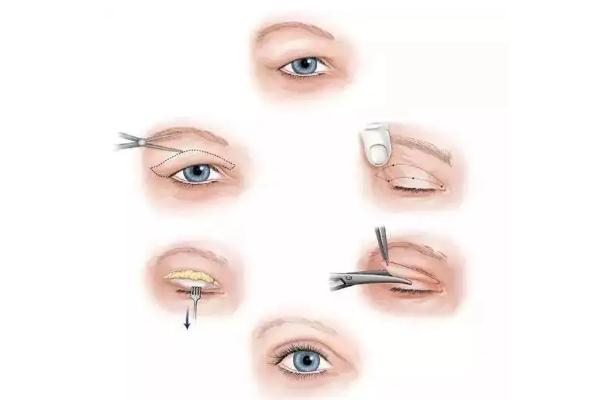 開眼角會顯老嗎 開眼角對眼睛有危害嗎 開眼角會顯老嗎 開眼角對眼睛有危害嗎