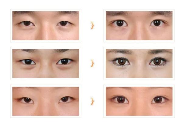 開(kāi)眼角的恢復(fù)期是多久 開(kāi)眼角要多久才能恢復(fù)正常 開(kāi)眼角的恢復(fù)期是多久 開(kāi)眼角要多久才能恢復(fù)正常