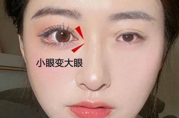 開眼角手術(shù)一般需要多少錢 開眼角手術(shù)危險(xiǎn)嗎 開眼角手術(shù)一般需要多少錢 開眼角手術(shù)危險(xiǎn)嗎