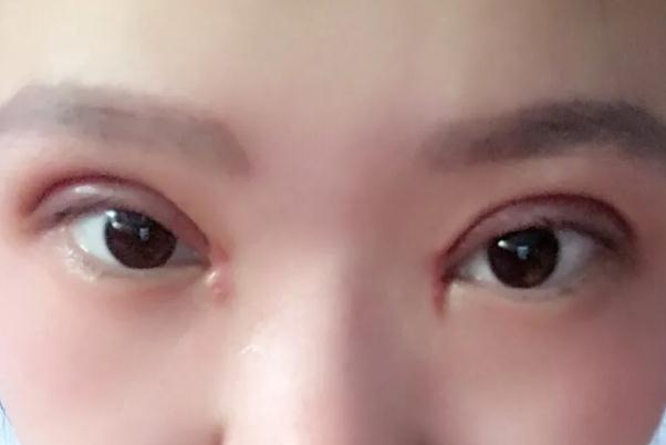 開(kāi)眼角的恢復(fù)期是多久 開(kāi)眼角要多久才能恢復(fù)正常 開(kāi)眼角的恢復(fù)期是多久 開(kāi)眼角要多久才能恢復(fù)正常