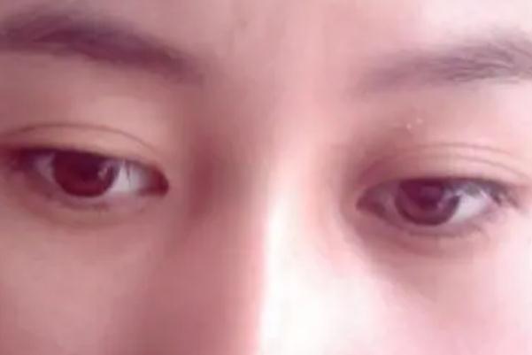 開眼角會顯老嗎 開眼角對眼睛有危害嗎 開眼角會顯老嗎 開眼角對眼睛有危害嗎